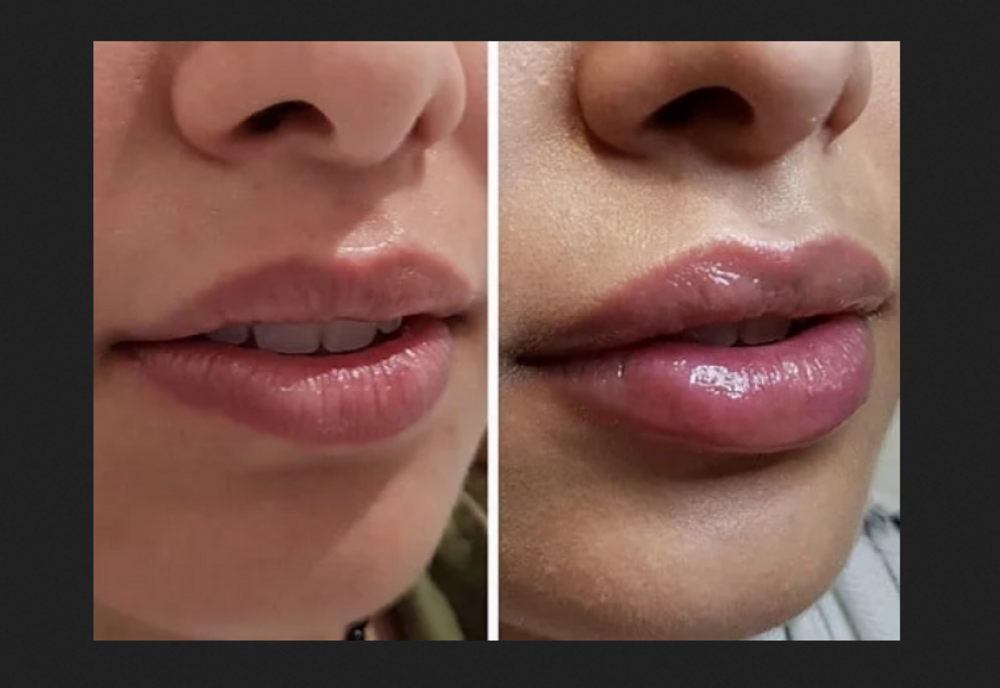 40.000 de lei amendă pentru un salon de înfrumusețare unde se practica ilegal procedura de mărire a volumului buzelor