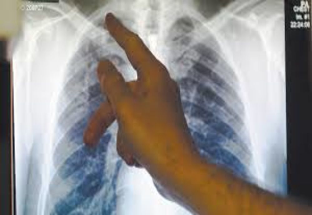 ROMÂNIA, PE PRIMUL LOC ÎN UE LA INCIDENȚA TUBERCULOZEI