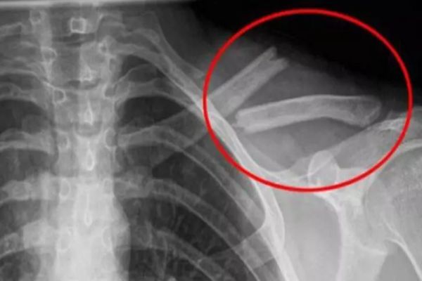 Otrava asta îţi distruge oasele! O bei în fiecare zi fără să știi cât de toxică este pentru organism