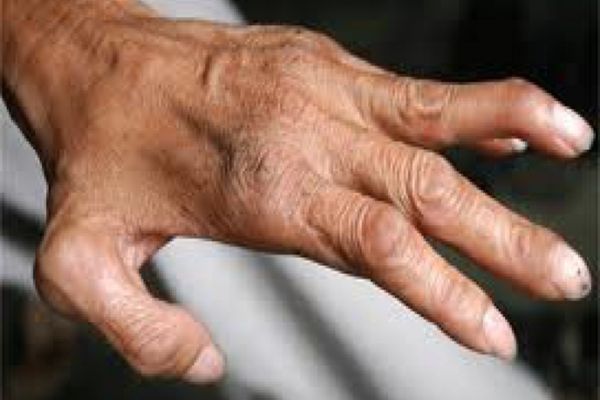 Alertă sanitară la Cluj, după depistarea a două cazuri de lepră la un centru SPA. Aproape 2.000 de clienți, notificați de DSP