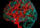 Accident Vascular Cerebral. Cum te recuperezi după un AVC. Ce simptome post-AVC poți avea